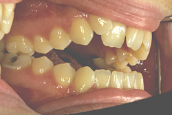 Beispielfall einer Zahnfehlstellung